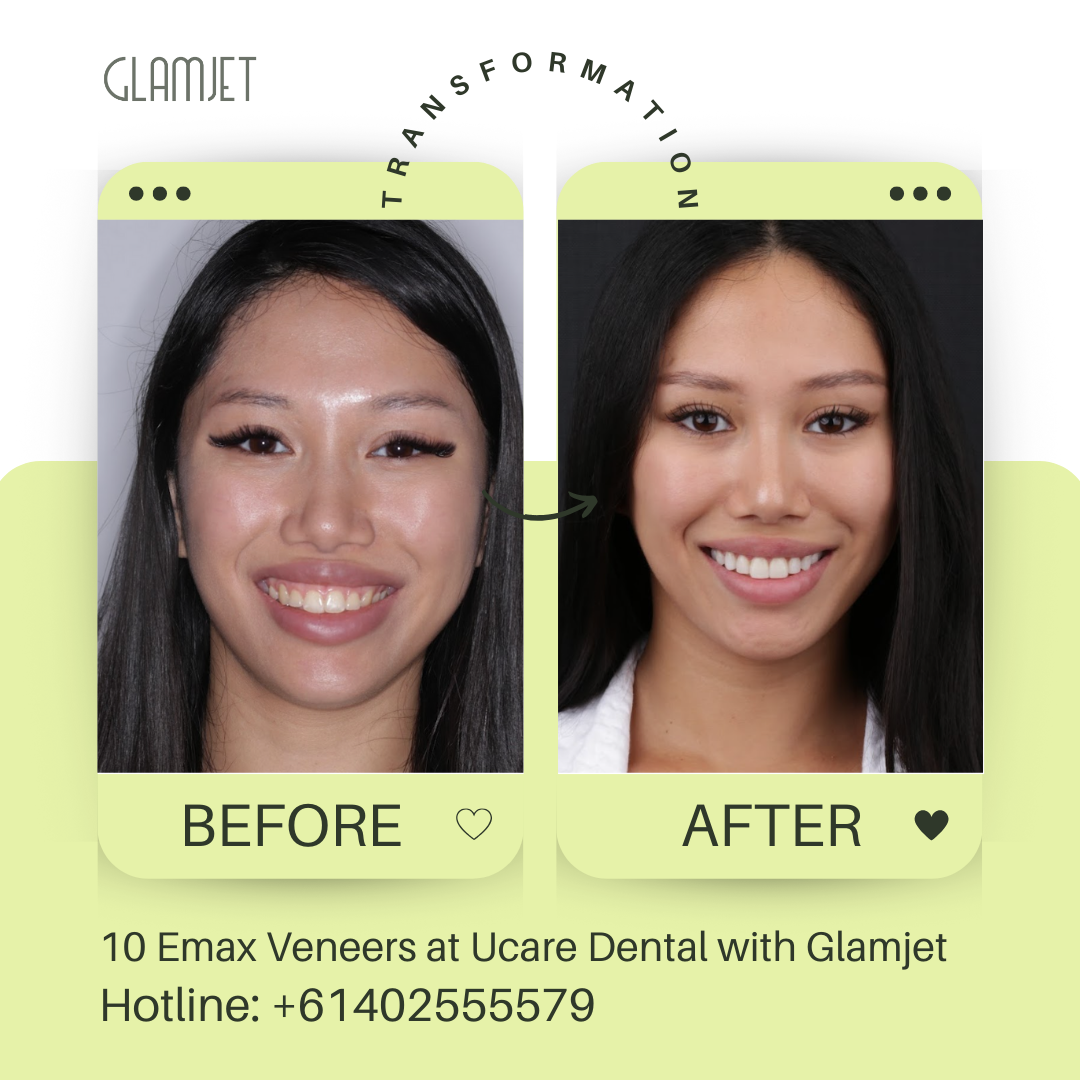 Before and after Emax Ceramic Veneers (no prep) at  Ucare Dental Clinic, Hanoi, Vietnam. Glamjet Dental Holiday connects clients from Australia, New Zealand, and the USA with expert Vietnamese dentists in Hanoi, Ho Chi Minh city, and Da Nang Vietnam. Clients enjoy dental holiday while  explore beautiful destination in Vietnam. Emax veneers are superior to porcelain veneers making them excellent choices for no prepration or minimal preparation veneers, and veneers replacement.