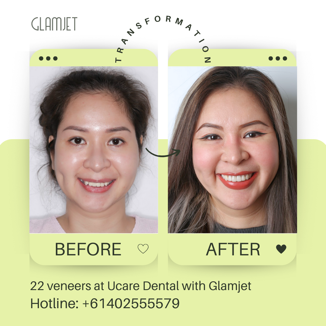 Emax Ceramic Veneers (no prep) transformation at Ucare Dental Clinic, Hanoi, Vietnam. Glamjet Dental Holiday combines expert dental care with breathtaking travel experiences in Hanoi, Ho Chi Minh City, and Da Nang. Glamjet's medical concierge service is trusted by many clients in Australians, New Zealand, and the USA.