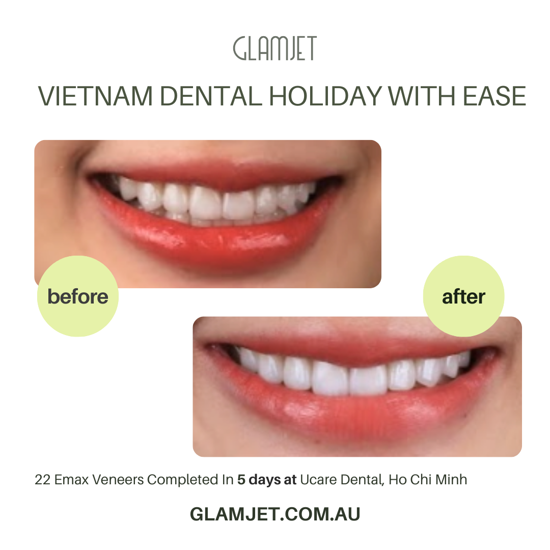 Complete smile transformation with Emax Ceramic Veneers at Ucare Dental Clinic, Hanoi, Vietnam. Glamjet Dental Holiday offers no-prep and minimal-prep veneers at affordable costs, significantly lower than prices in Australia, New Zealand, and the USA, alongside unforgettable Vietnam travel experiences.