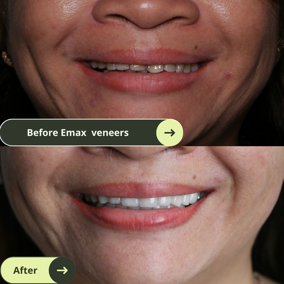 Women looks happy and confident with beautiful smiles after 20 Emax Veneers Package in Vietnam. Photo shows before and after Emax veneers smile makeover in Vietnam. Emax porcelain veneers packages in Vietnam are much more affordable than in Melbourne, Sydney, Perth, or Brisbane, Australia or even Thailand and Bali. Emax veneers are more premium than traditional veneer. They look translucent and mimic the colour of natural teeth. Glamjet offers 6 veneer, 10 veneer, 16 veneer packages