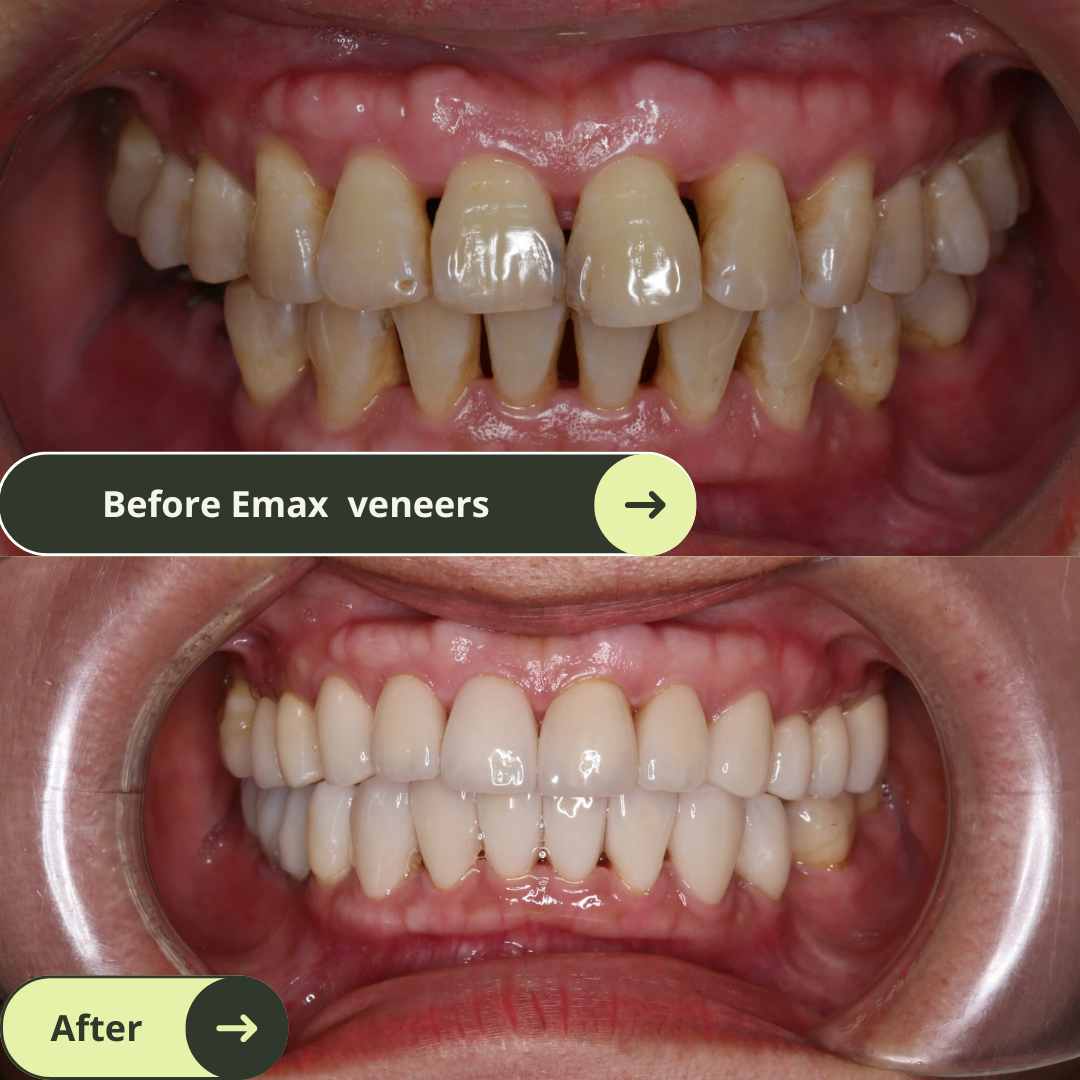 Women looks happy and confident with beautiful smiles after 20 Emax Veneers Package in Vietnam. Photo shows before and after Emax veneers smile makeover in Vietnam. Emax porcelain veneers packages  in Vietnam are much more affordable than in Melbourne, Sydney, Perth, or Brisbane, Australia or even Thailand and Bali. Emax veneers are more premium than traditional veneer. They look translucent and mimic the colour of natural teeth. Glamjet offers 6 veneer, 10 veneer, 16 veneer packages
