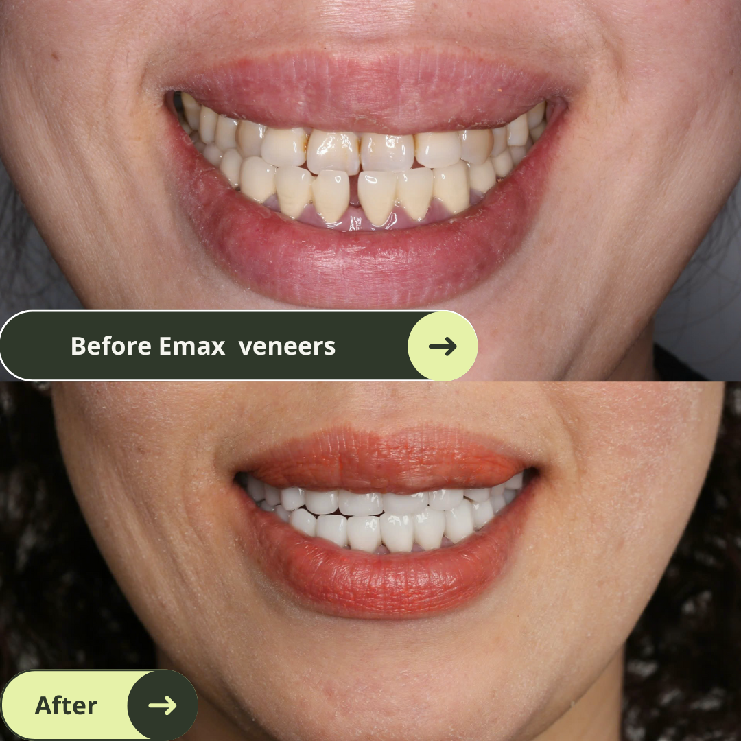 Women looks happy and confident with beautiful smiles after 18 Emax Veneers Package in Vietnam. Photo shows before and after Emax veneers smile makeover in Vietnam. Emax porcelain veneers packages in Vietnam are much more affordable than in Melbourne, Sydney, Perth, or Brisbane, Australia or even Thailand and Bali. Emax veneers are more premium than traditional veneer. They look translucent and mimic the colour of natural teeth. Glamjet offers 6 veneer, 10 veneer, 16 veneer packages