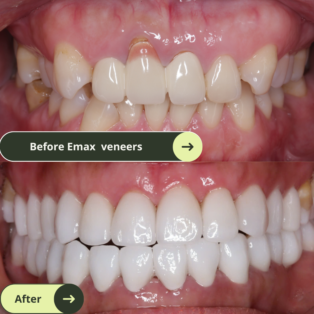 Women looks happy and confident with beautiful smiles after 22 Emax Ceramic Veneers Package  and treating gum infection at a top rated dental clinic in Ho Chi Minh City, Vietnam. Emax veneers are more premium than traditional veneer. Glamjet offers 6 veneer, 10 veneer, 16 veneer packages. Prices in Vietnam are much more affordable than Melbourne, Sydney, Adelaide, the USA, or New Zealand.