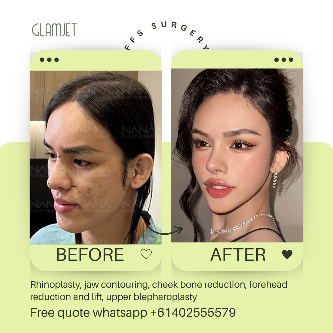 Before and after facial feminisation surgery in South Korea with glamjet.com.au at Nana plastic surgery hospital in South Korea