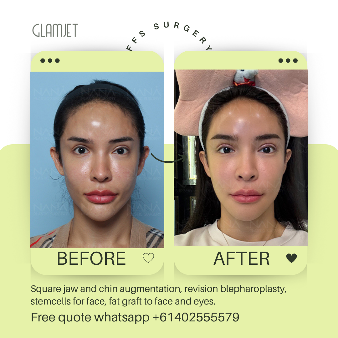 Before and after facial feminisation surgery in South Korea with glamjet.com.au at Nana plastic surgery hospital in South Korea jaw contouring rhinoplasty upper blepharoplasty, fat graft for eyes and face