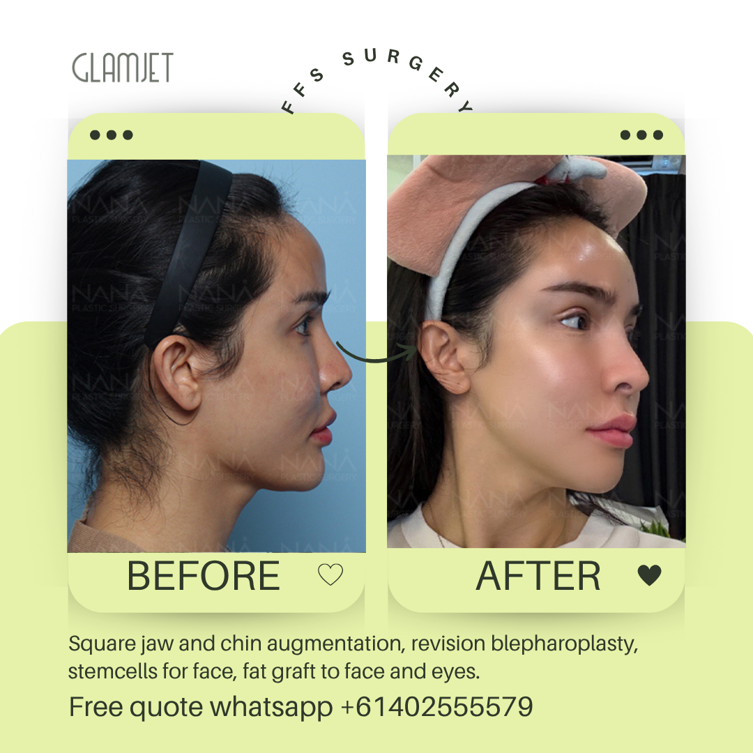 Before and after facial feminisation surgery in South Korea with glamjet.com.au at Nana plastic surgery hospital in South Korea jaw contouring rhinoplasty upper blepharoplasty, fat graft for eyes and face