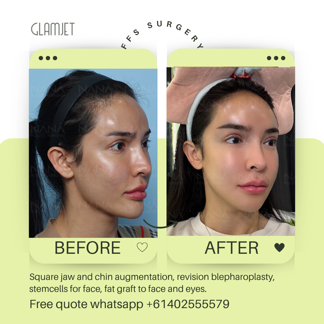 Before and after facial feminisation surgery in South Korea with glamjet.com.au at Nana plastic surgery hospital in South Korea jaw contouring rhinoplasty upper blepharoplasty, fat graft for eyes and face, forehead reduction