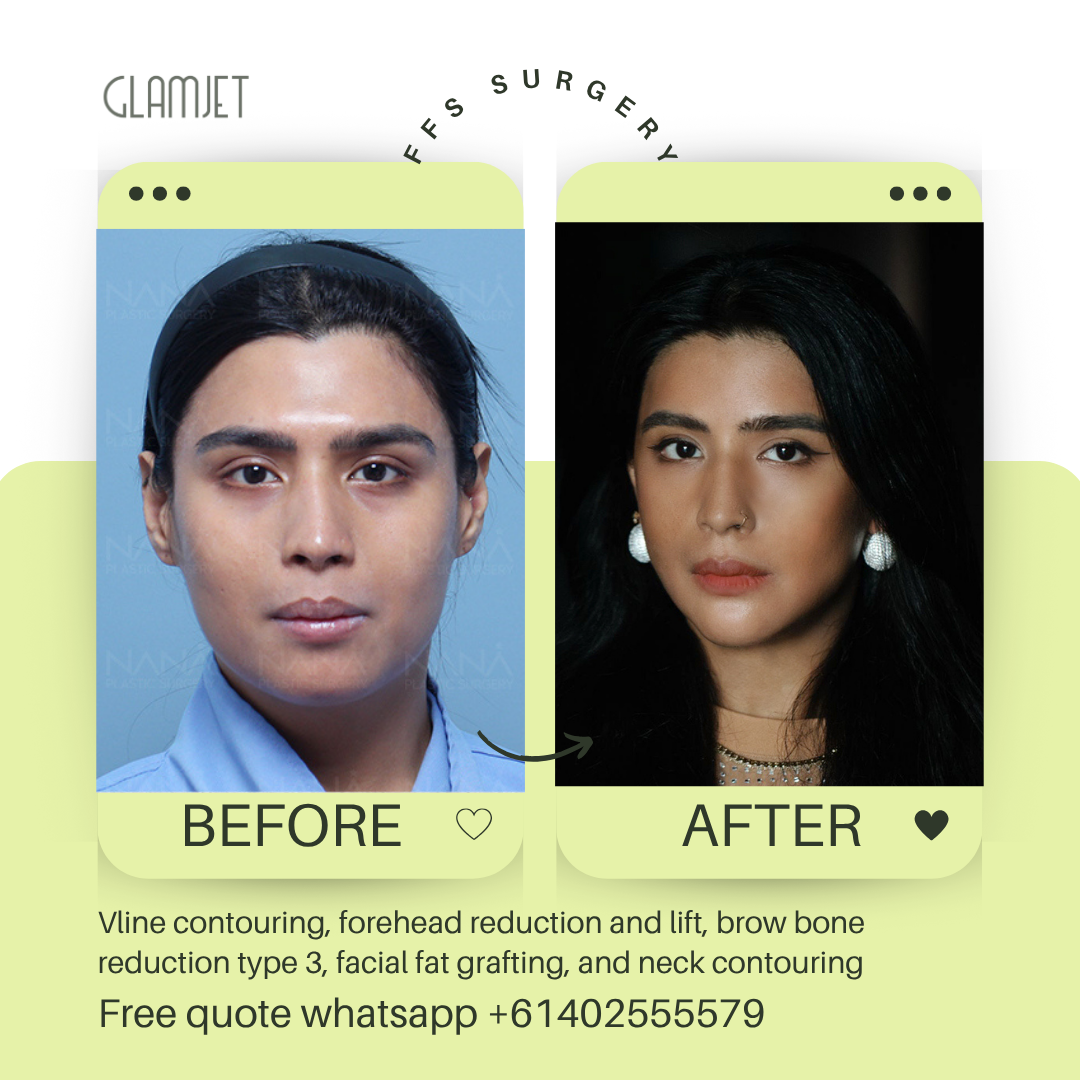 Before and after facial feminisation surgery in South Korea with glamjet.com.au at Nana plastic surgery hospital in South Korea jaw contouring rhinoplasty upper blepharoplasty, fat graft for eyes and face, forehead reduction, brow bone reduction type 3
