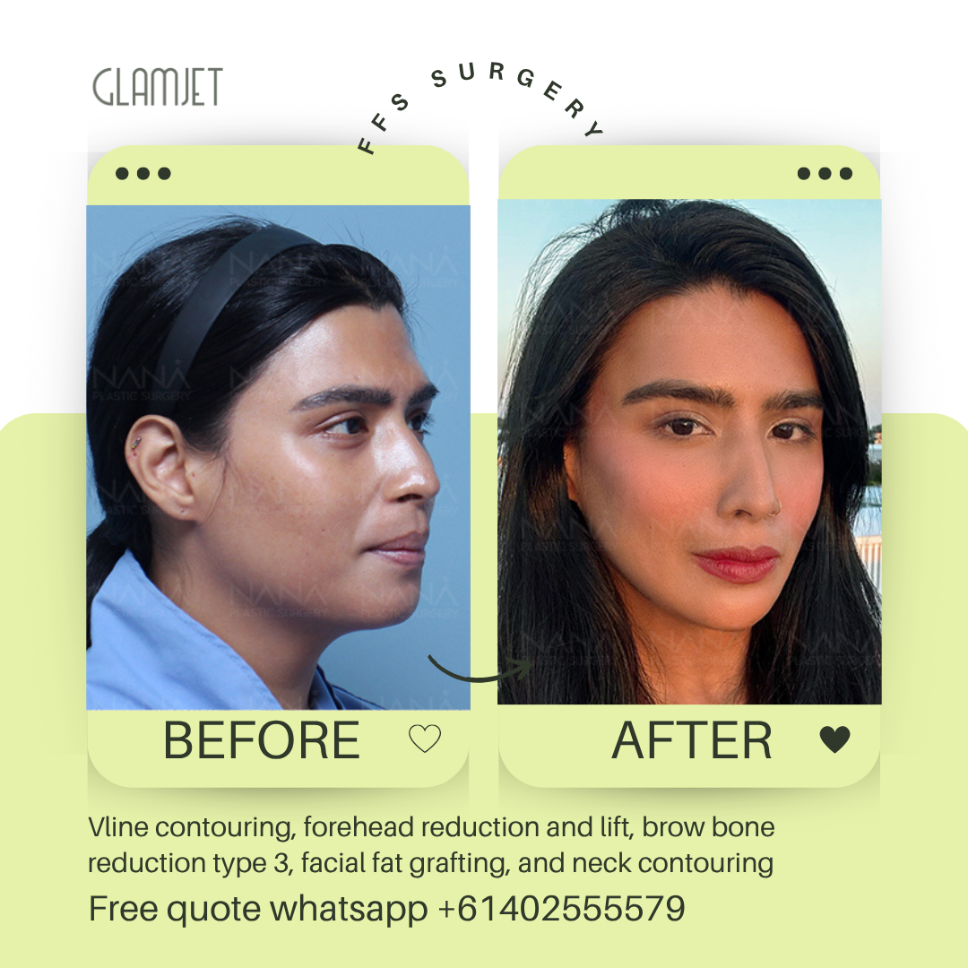 Before and after facial feminisation surgery in South Korea with glamjet.com.au at Nana plastic surgery hospital in South Korea jaw contouring rhinoplasty upper blepharoplasty, facial fat grafting,  forehead reduction, brow bone reduction type 3 and neck contouring