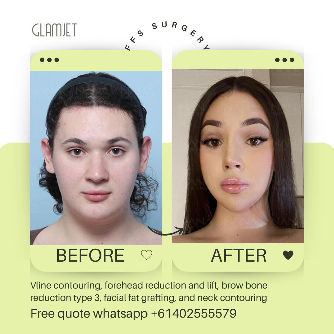 Before and after facial feminisation surgery in South Korea with glamjet.com.au at Nana plastic surgery hospital in South Korea jaw contouring rhinoplasty upper blepharoplasty, fat graft for eyes and face, forehead reduction, brow bone reduction type 3