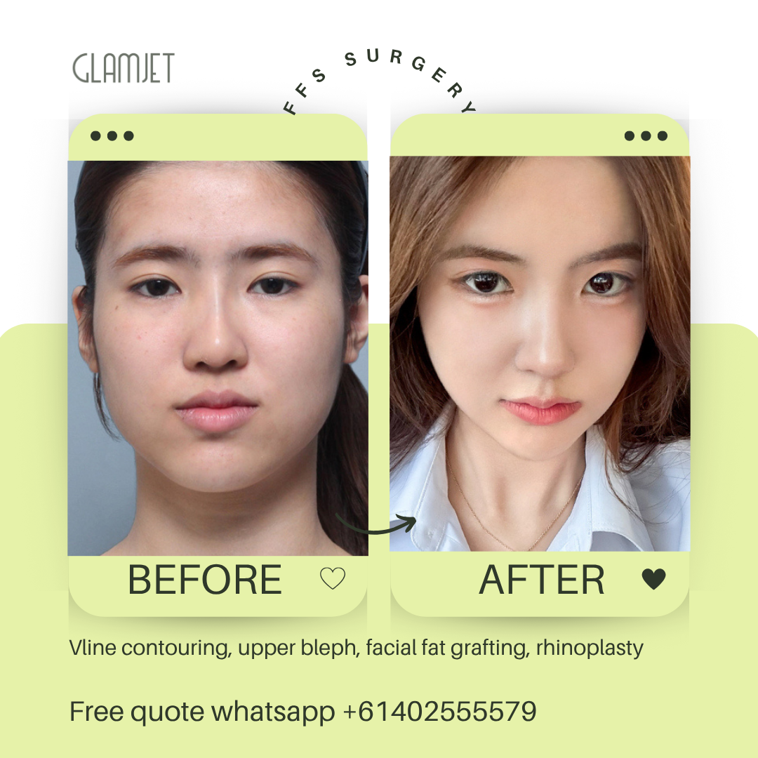 Before and after facial feminisation surgery in South Korea with glamjet.com.au at Nana plastic surgery hospital in South Korea jaw contouring rhinoplasty upper blepharoplasty, facial fat graft