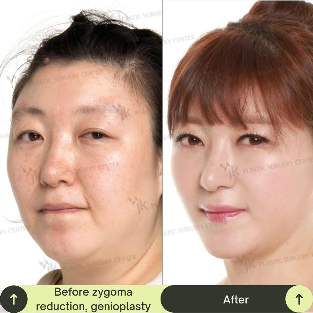 Cheek Bone Zygomatic Reduction Packages In South Korea