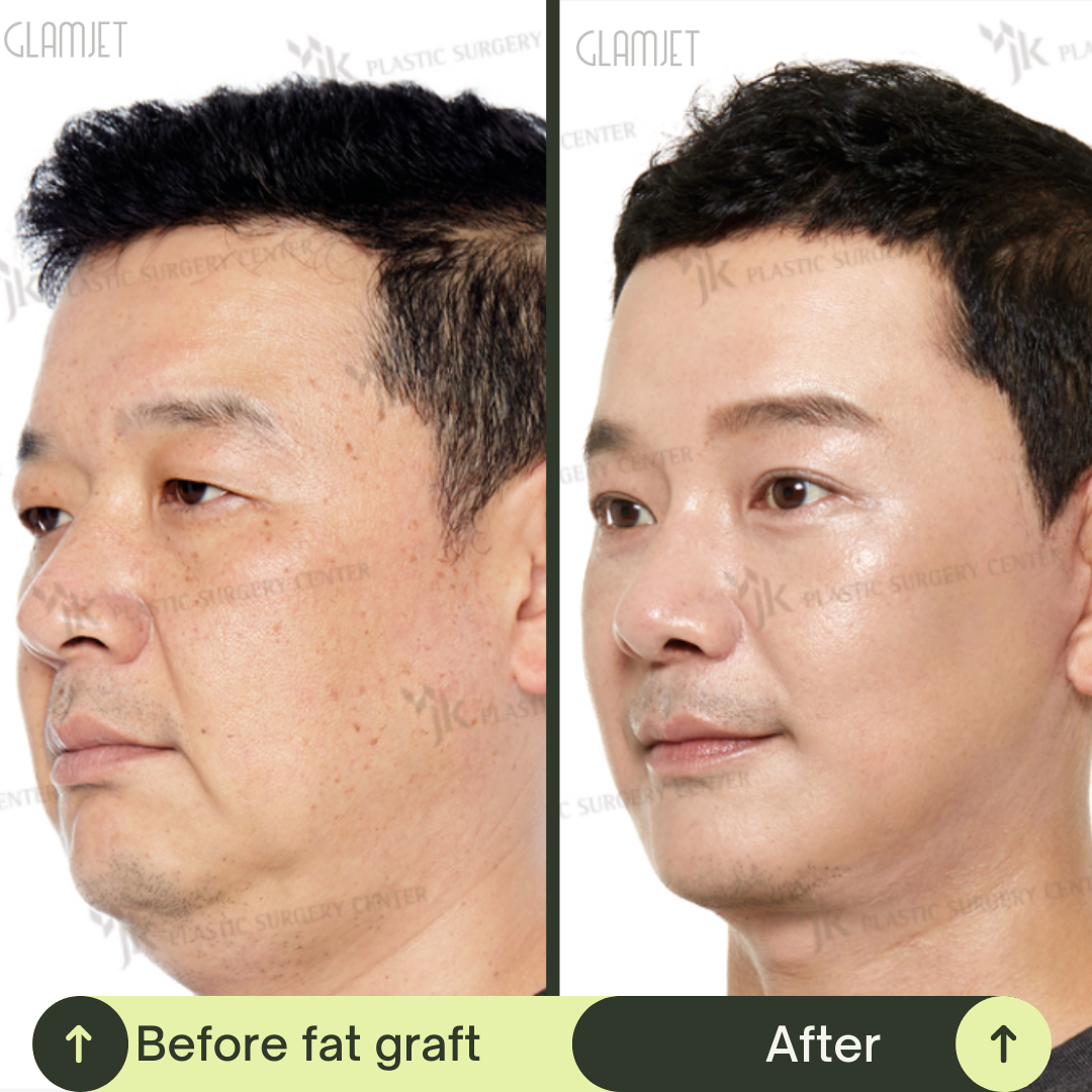 Men Deep Plane Face Lift Packages in South Korea