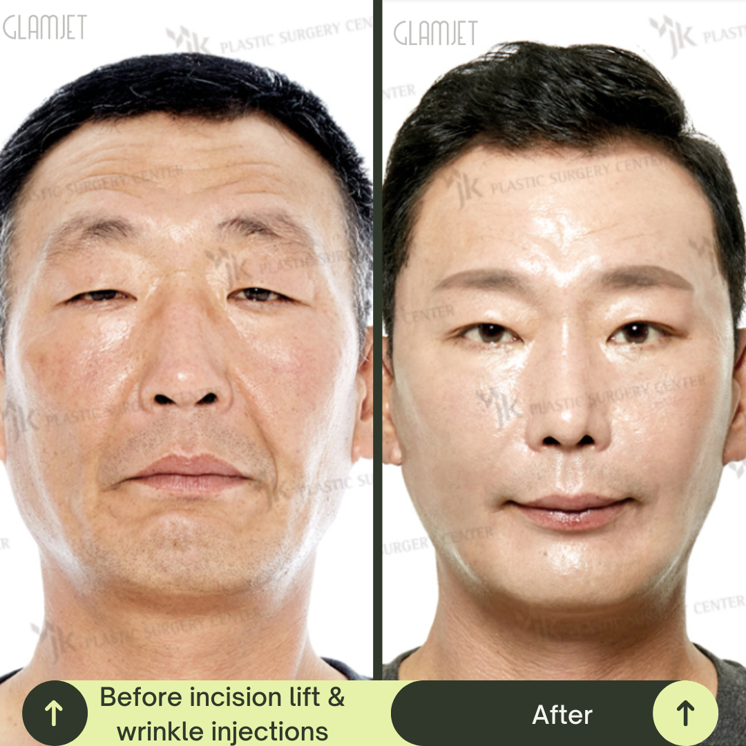 Men Deep Plane Face Lift Packages in South Korea