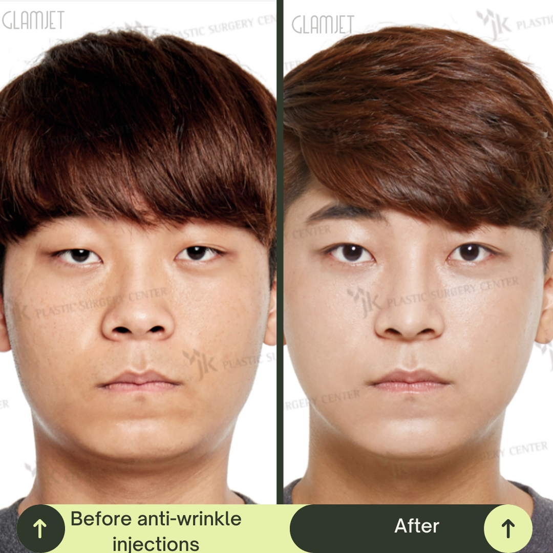 Men Deep Plane Face Lift Packages in South Korea