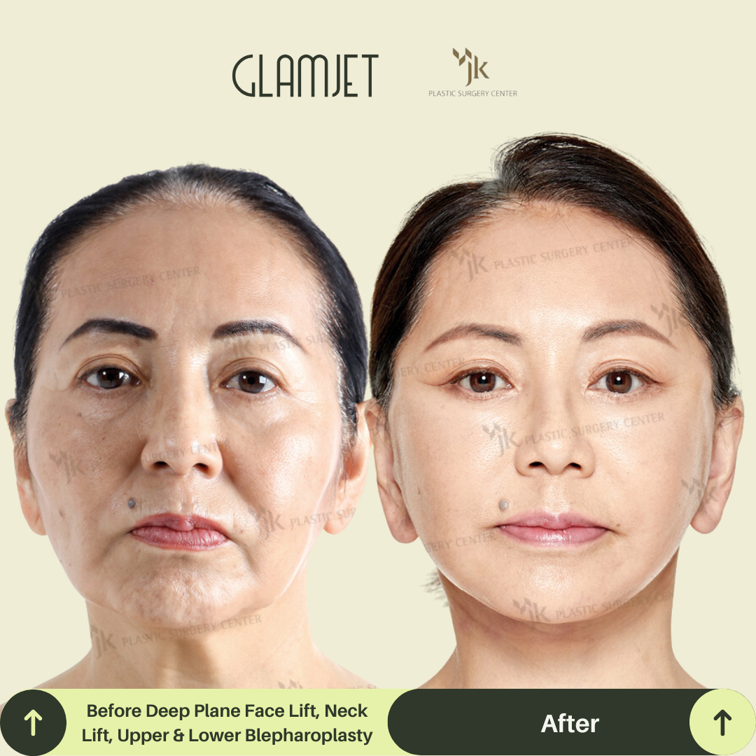 Before and after neck lift surgery results for an Australian woman in her 50s who travelled to Seoul, South Korea for SMAS facelift and neck lift with Glamjet.com.au’s medical concierge service. Visible improvements in jawline definition and loose skin reduction.