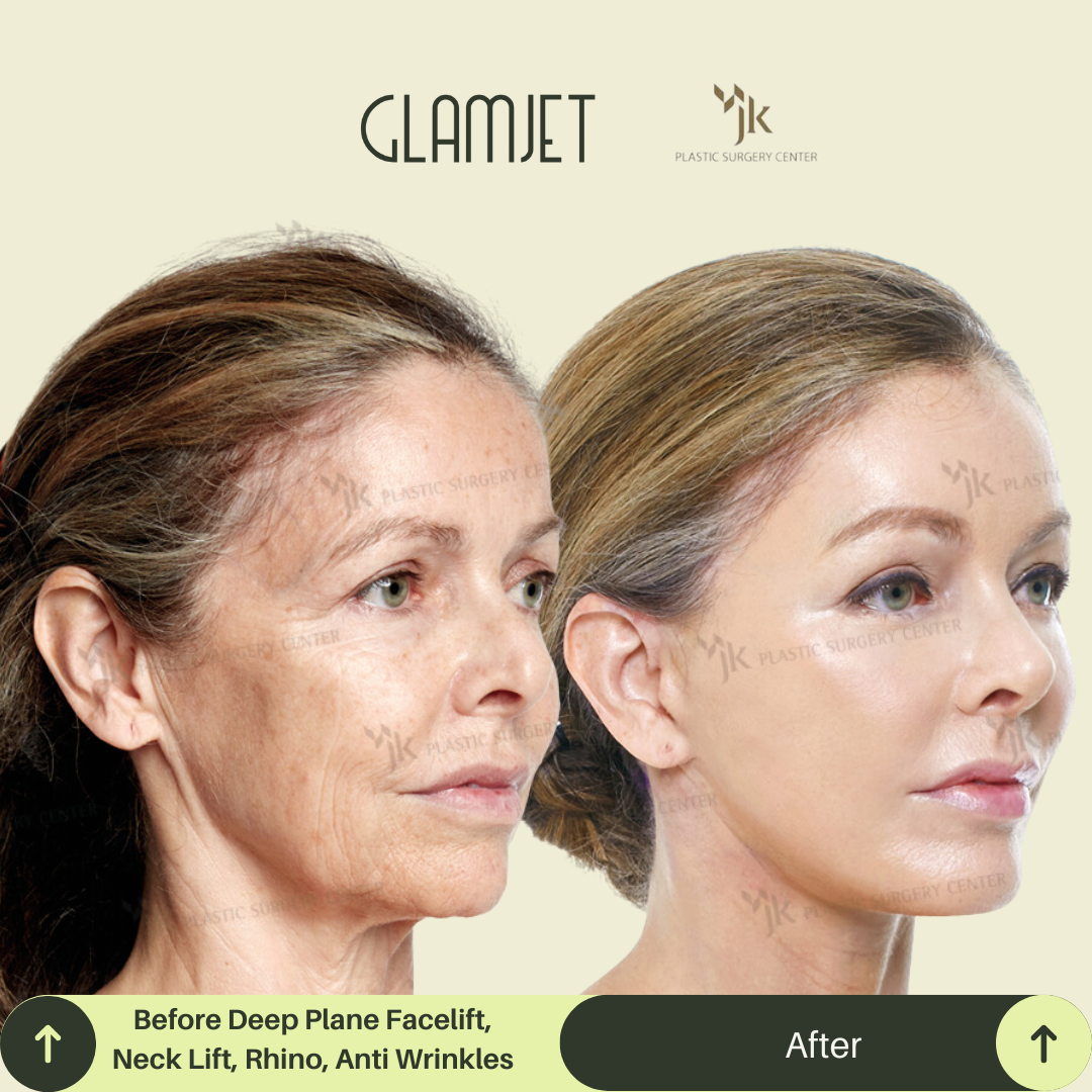Before and after of a woman in her 50s after neck lift and lower facelift surgery in South Korea. Procedure performed by a top board-certified neck lift surgeon in Seoul through Glamjet.com.au’s expert medical concierge service.