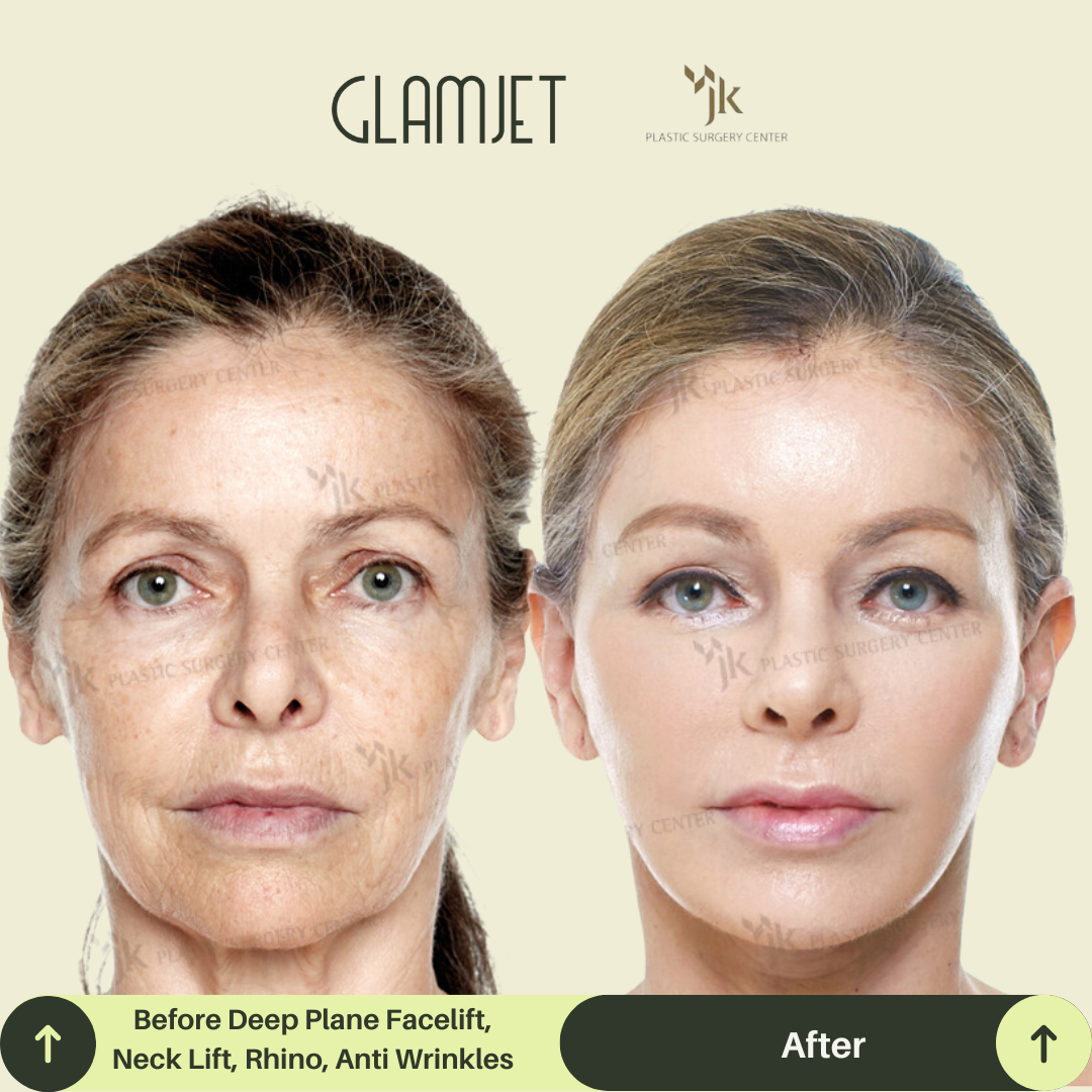 Before and after of a middle-aged woman after Deep Plane facelift and neck lift at JK Plastic Surgery in Gangnam, South Korea. Procedure performed by a board-certified plastic surgeon recommended by Glamjet.com.au . Results show tightened neck skin and lifted lower face.