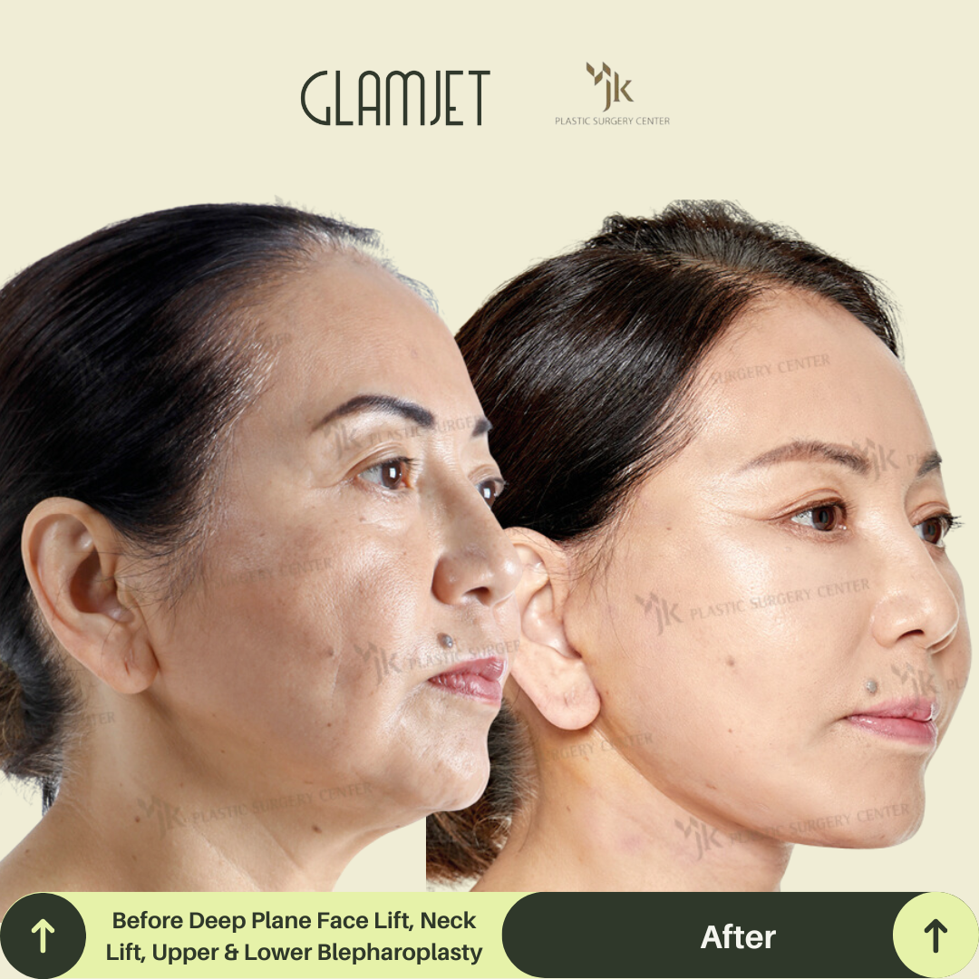 Transformation photo of a client from New Zealand post neck lift and facelift surgery in South Korea with Glamjet.com.au . Results highlight smoother neckline, defined chin, and rejuvenated facial contour. Popular plastic surgery destination for Australians and Kiwis.