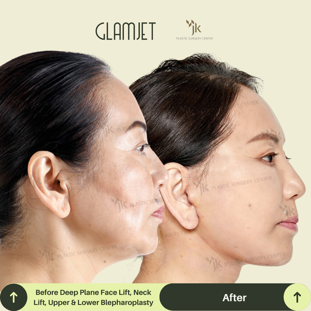 Before and after image of combined neck lift, SMAS facelift, and CO2 laser skin treatment in Seoul, South Korea. Glamjet.com.au connects patients from Australia and North America with top Korean plastic surgeons for anti-aging facial surgery.