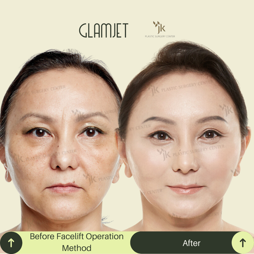 Visible anti-aging results after SMAS facelift and neck lift in South Korea performed on a 55-year-old client. Procedure coordinated by Glamjet.com.au , avoiding factory-style clinics. Ideal for sagging neck skin, jowls, and double chin.