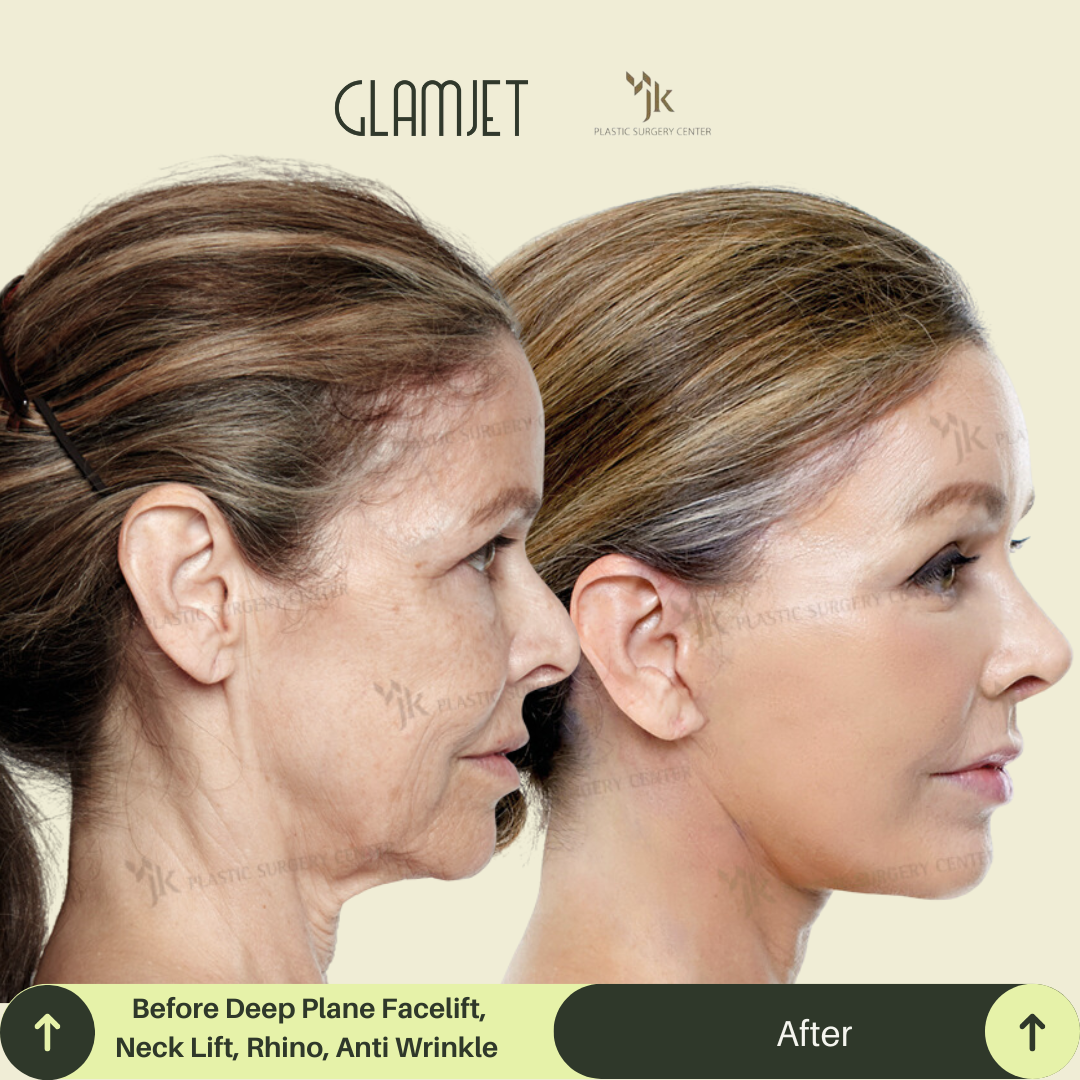 Before and after comparison of a woman's face after neck lift procedure with top rated neck plastic surgeon in Seoul, South Korea. Medical tourism trip was arranged by Glamjet