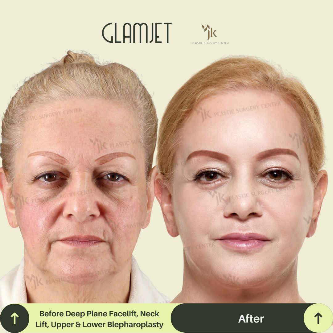 Before and after image of an Australian woman who received a neck lift and facelift by one of the best plastic surgeons in South Korea. Glamjet helped connect her with a top-tier, board-certified surgeon in Gangnam, Seoul for natural, long-lasting results.