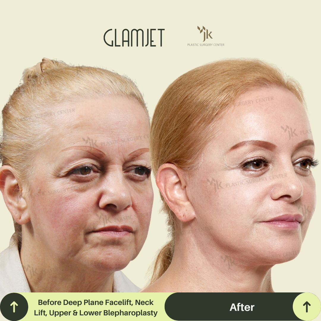 Visible transformation after a lower face and neck lift performed by a leading neck lift surgeon in South Korea. Glamjet.com.au provides medical concierge services to Australians and international clients seeking expert facial rejuvenation surgery.