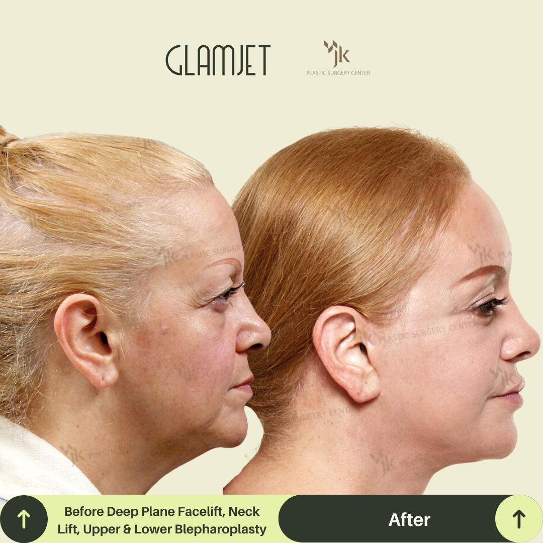Dramatic facelift and neck lift before and after results in South Korea by a highly recommended plastic surgeon. This procedure included SMAS lift, platysmal neck tightening, and was arranged through Glamjet’s premium surgery matching service.