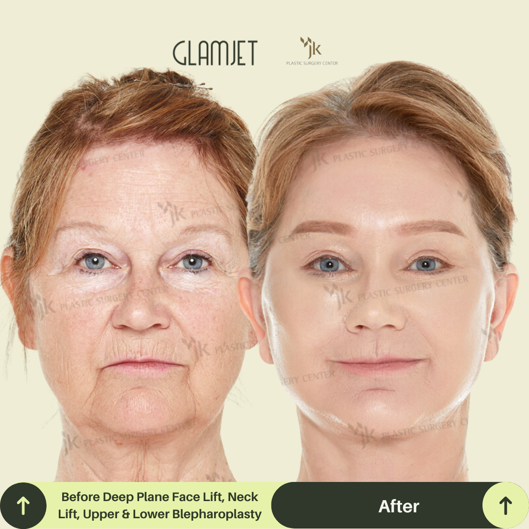 Jawline and neck lift transformation after facial surgery in Gangnam, Seoul. Procedure by a board-certified plastic surgeon matched through Glamjet.com.au , a trusted concierge for Australians seeking the best facelift and neck lift specialists in South Korea.