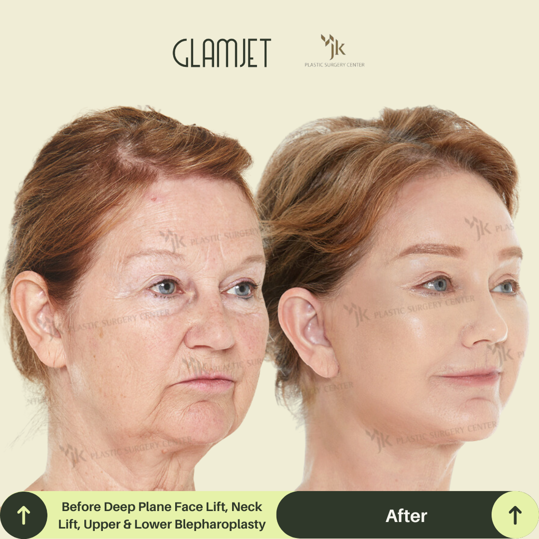 Side profile of a middle-aged client showing youthful contour after a facelift and neck lift performed by one of South Korea’s best plastic surgeons. Glamjet.com.au connects overseas clients with expert anti-aging specialists in Seoul.