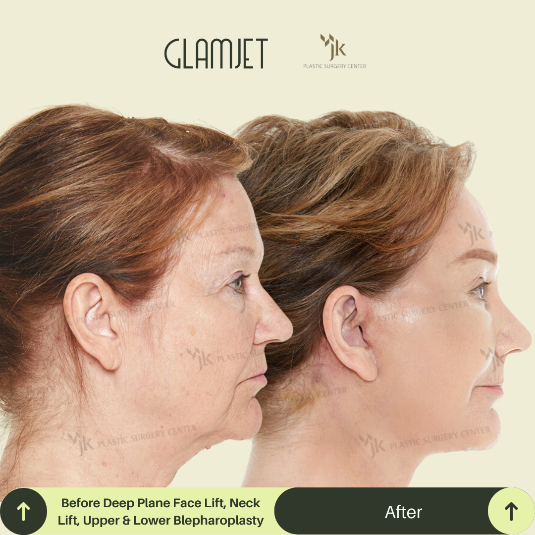 Dramatic facelift and neck lift before and after results in South Korea by a highly recommended plastic surgeon. This procedure included SMAS lift, platysmal neck tightening, and was arranged through Glamjet.com.au’s premium surgery matching service.