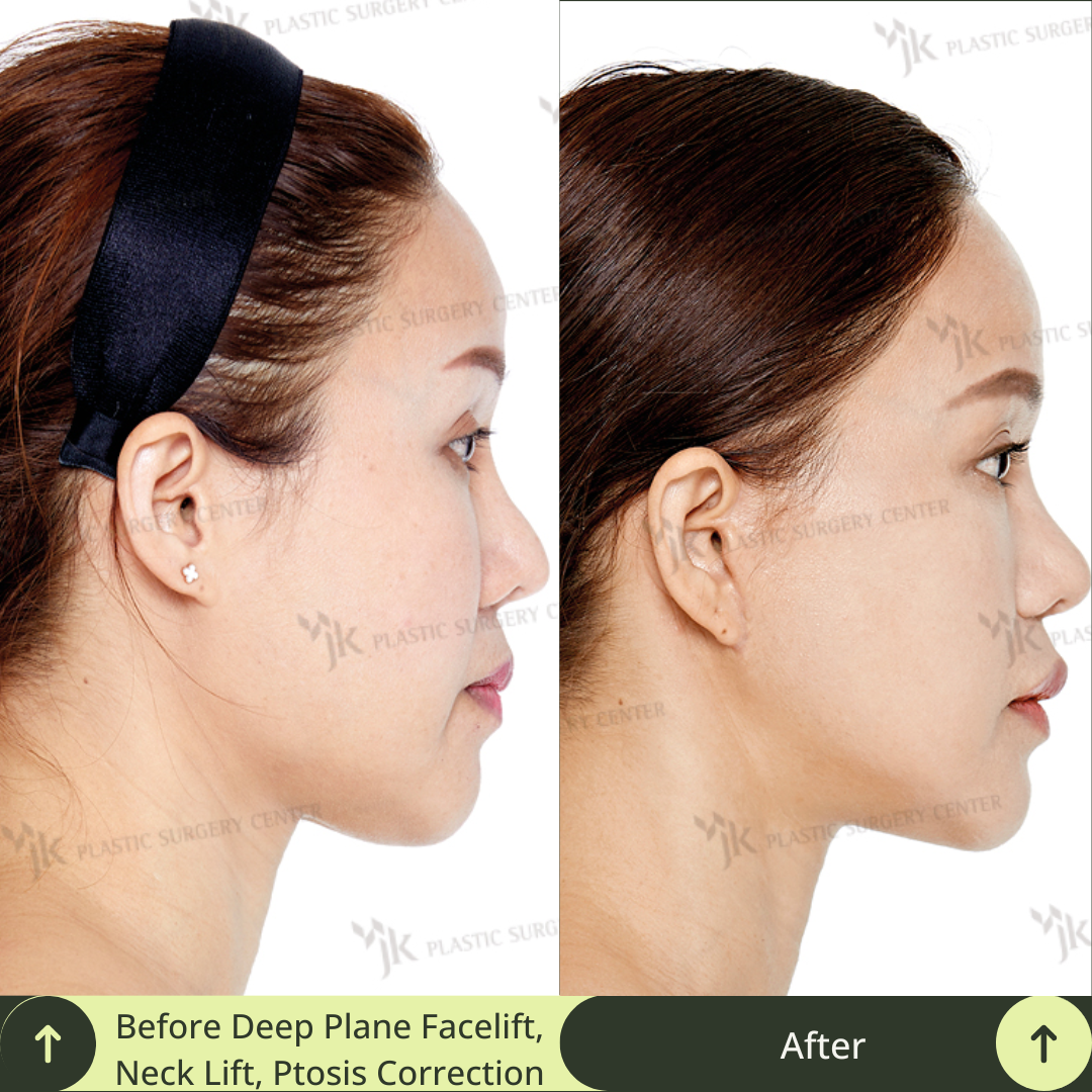 Discover the remarkable impact before and after a deep plane SMAS facelift , neck lift and ptosis correction surgery in Gangnam, Seoul, South Korea. Glamjet offers premium medical tourism concierge services to international clients, guiding them to top board certified plastic surgeons in Gangnam for individualised care and exceptional outcomes.