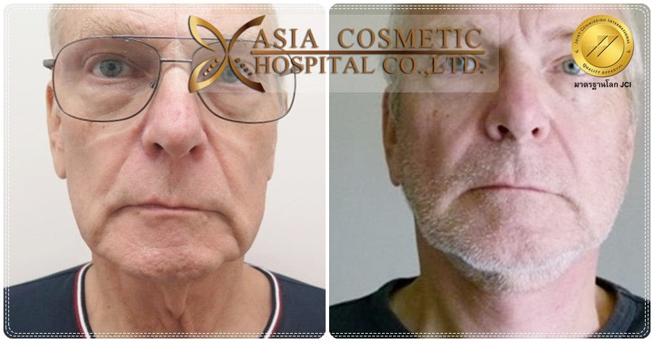 Men SMAS Face Lift Packages in Thailand