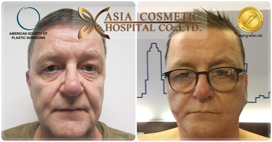 Men SMAS Face Lift Packages in Thailand