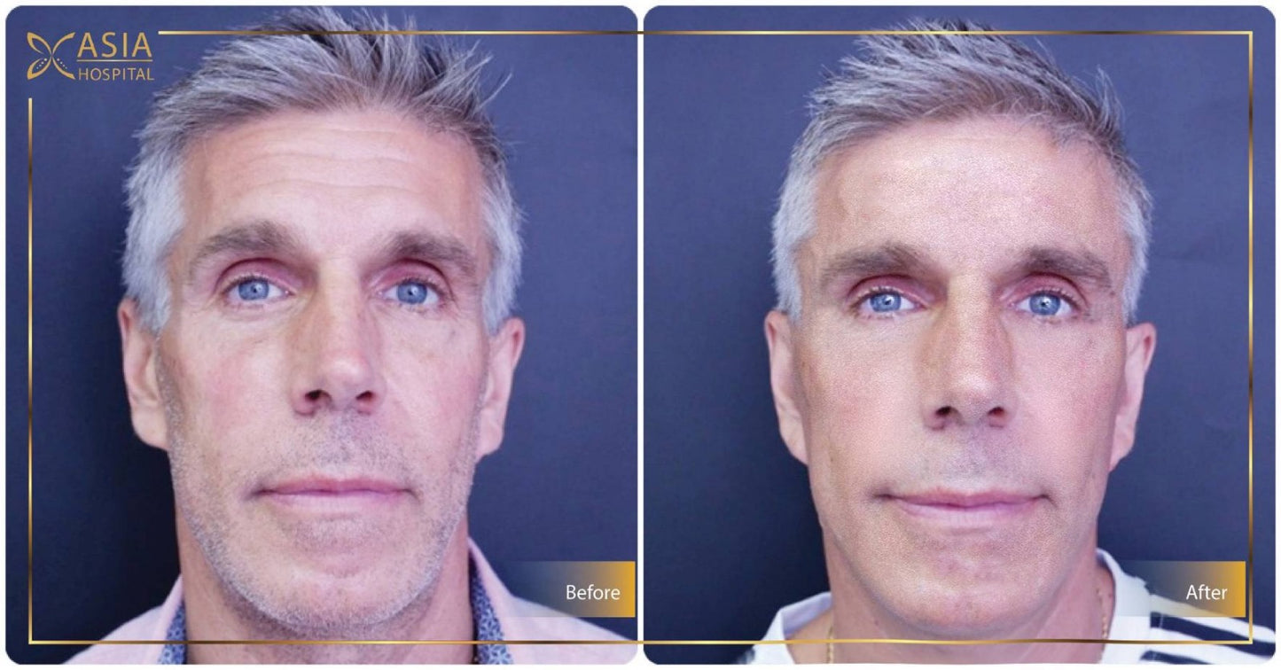 Men SMAS Face Lift Packages in Thailand