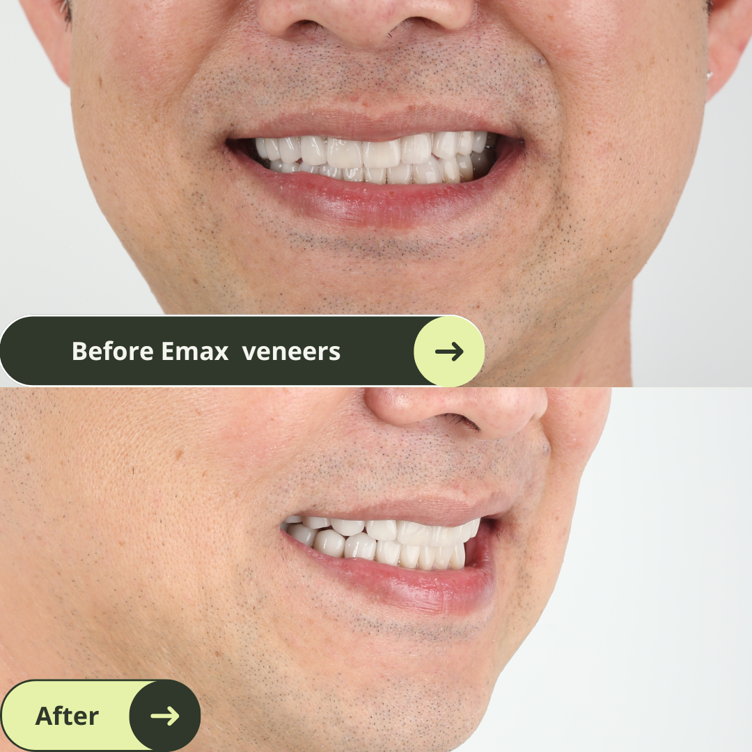 A male client looks so much happier after he had 16 EMAX porcelain veneer packages in Ho Chi Minh city Vietnam. Price per tooth is from $450 instead of $2500-$2800/tooth in Melbourne, Sydney, Perth, or Brisbane, Australia. Emax veneers are translucent and mimic the colour of natural teeth. Glamjet offers 6 veneer, 10 veneer, 16 veneer packages in Vietnam, Thailand, and South Korea with payment plans. Price of porcelain veneers are 70% cheaper than Australia. Whole process only takes 1-2 days