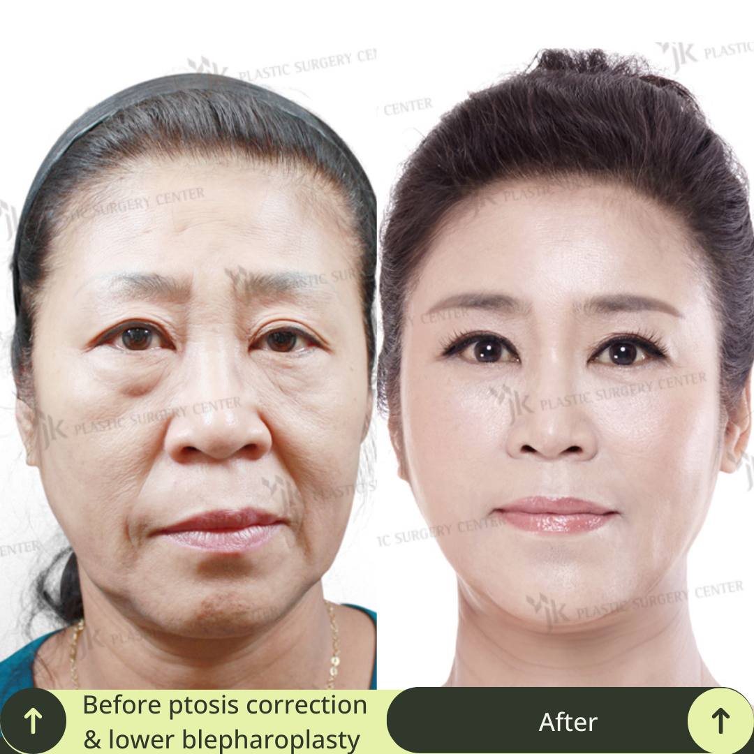 Upper Blepharoplasty Surgery Packages in South Korea