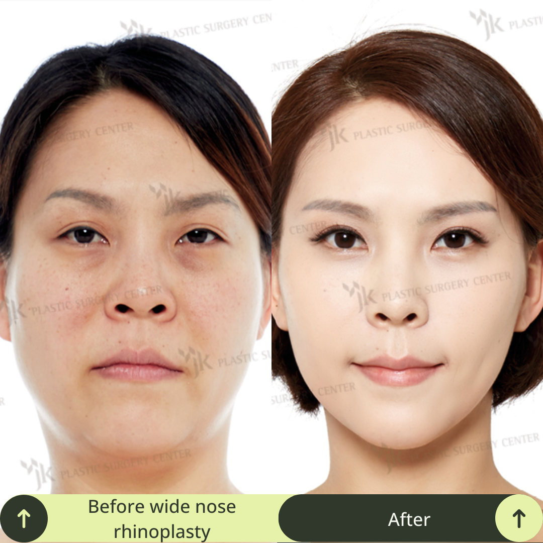Women Rhinoplasty Surgery Packages In South Korea