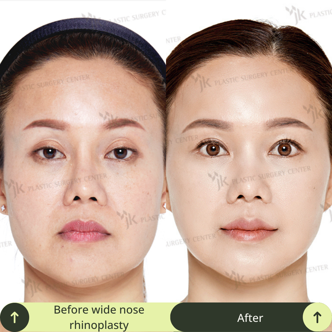 Women Rhinoplasty Surgery Packages In South Korea