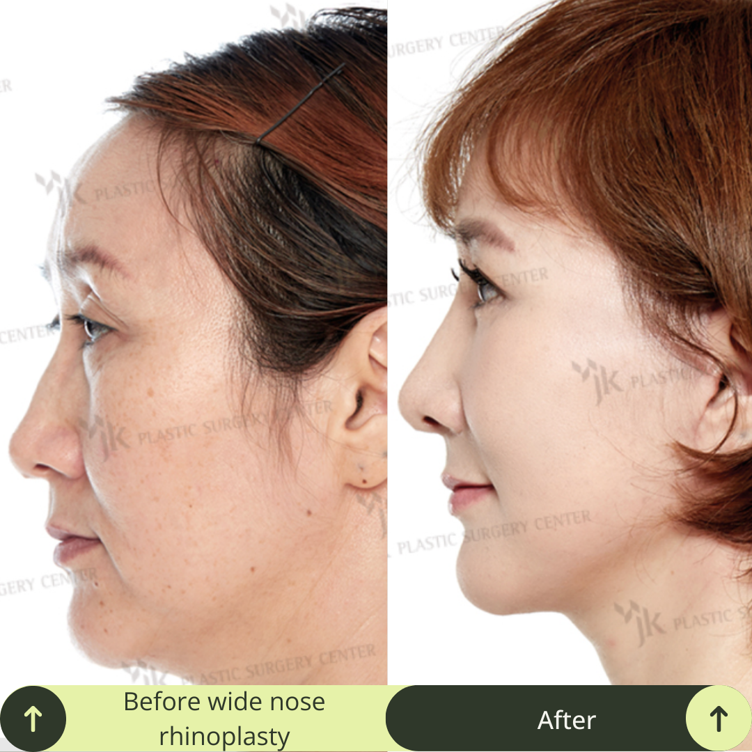 Women Rhinoplasty Surgery Packages In South Korea