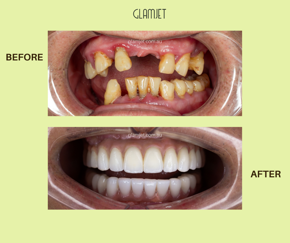 All-on-4 Dental Implants Package In Vietnam. Payment Plans Available