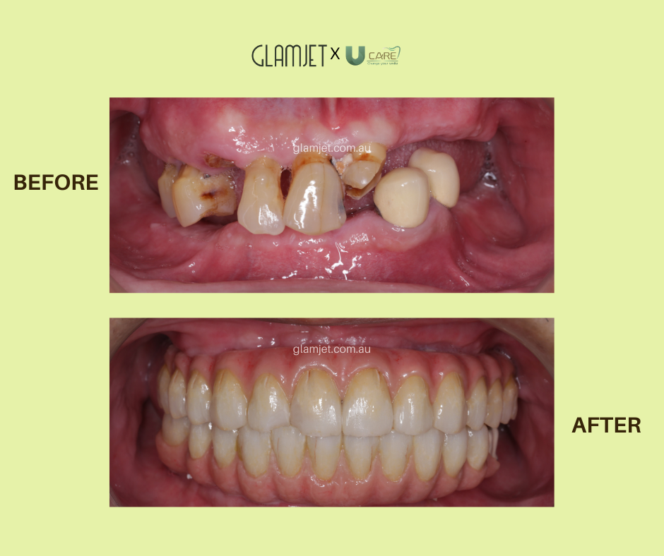 Before and after of all-on-4 dental implants top and bottom at the best dental clinic in Vietnam with Glamjet.