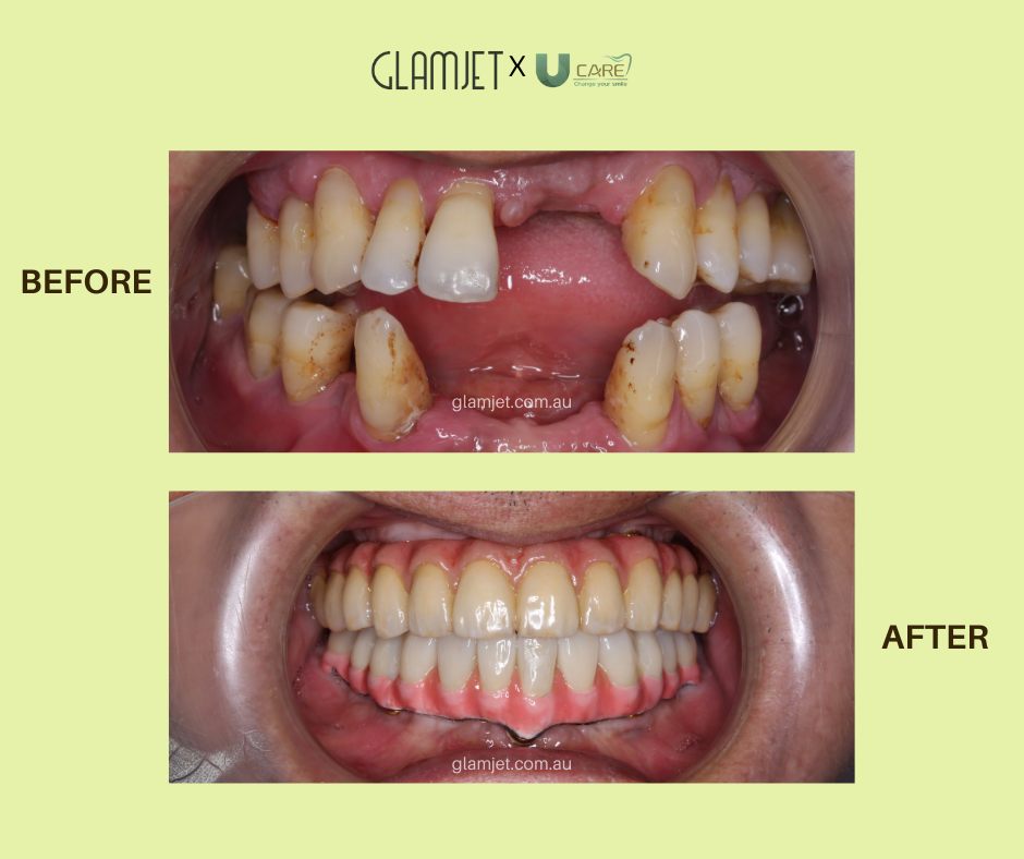 Before and after of all-on-4 dental implants top and bottom by the best dentist in Vietnam with Glamjet