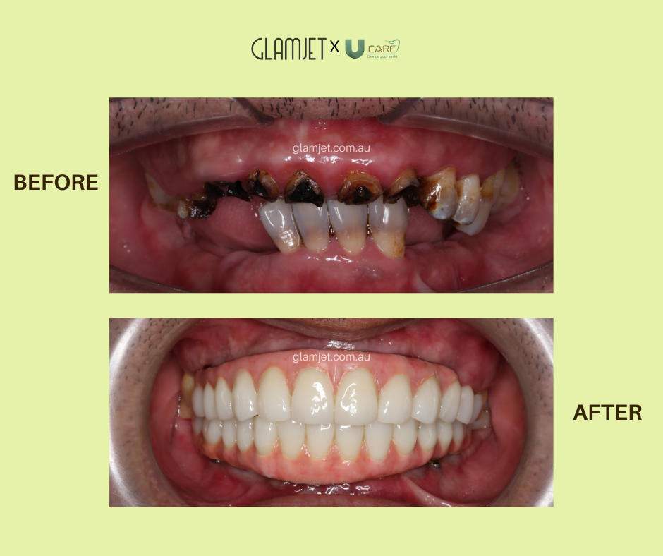 Before and after all-on-4 dental implants in Vietnam with Glamjet. A client has a full smile makeover and is much more confident with his smile.