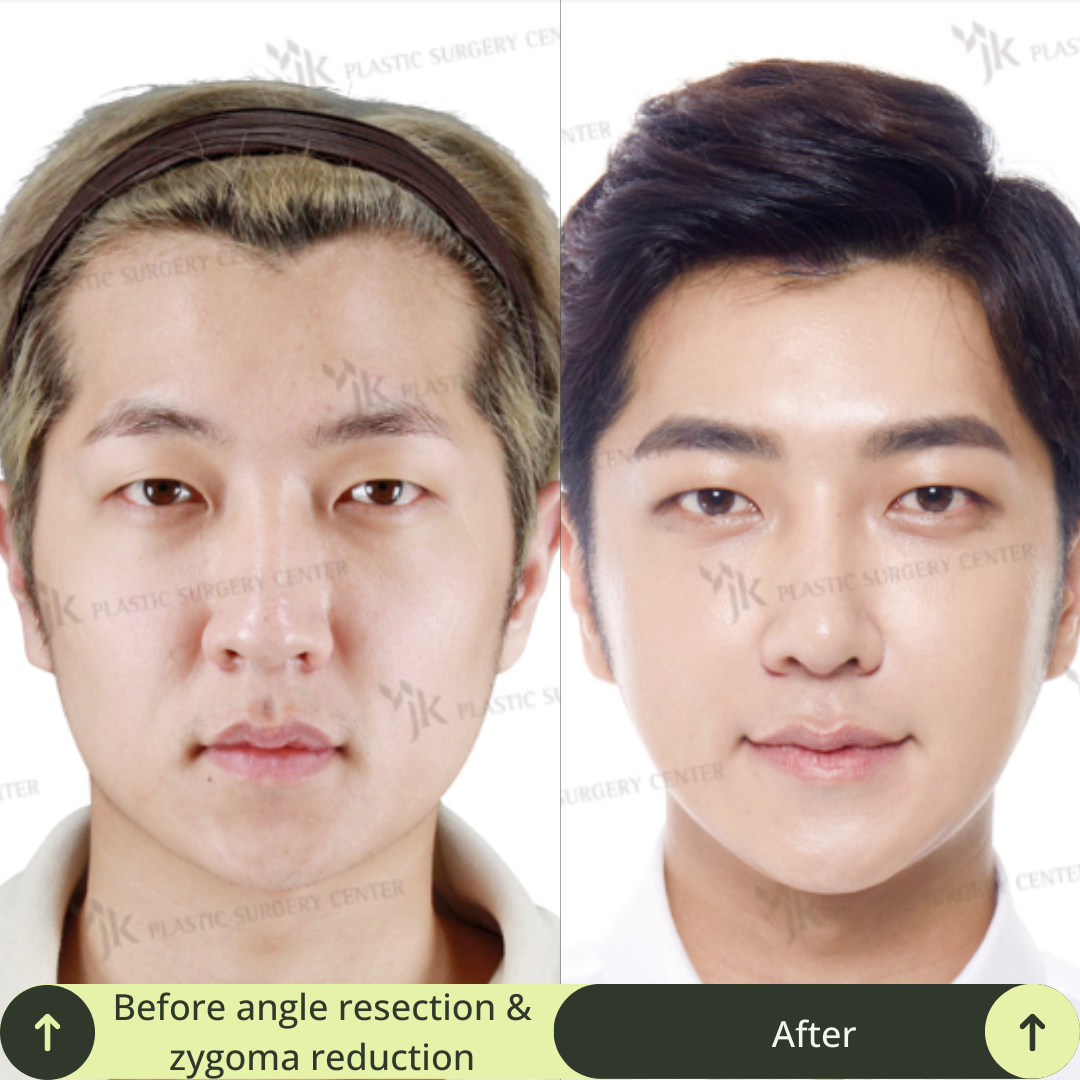 Men Vline Jaw Surgery Packages In South Korea