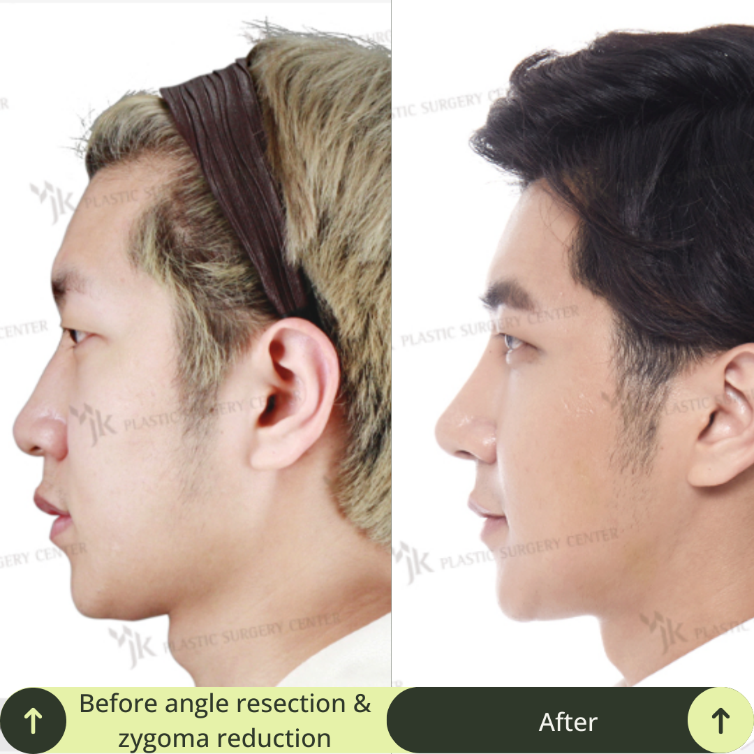 Men Vline Jaw Surgery Packages In South Korea