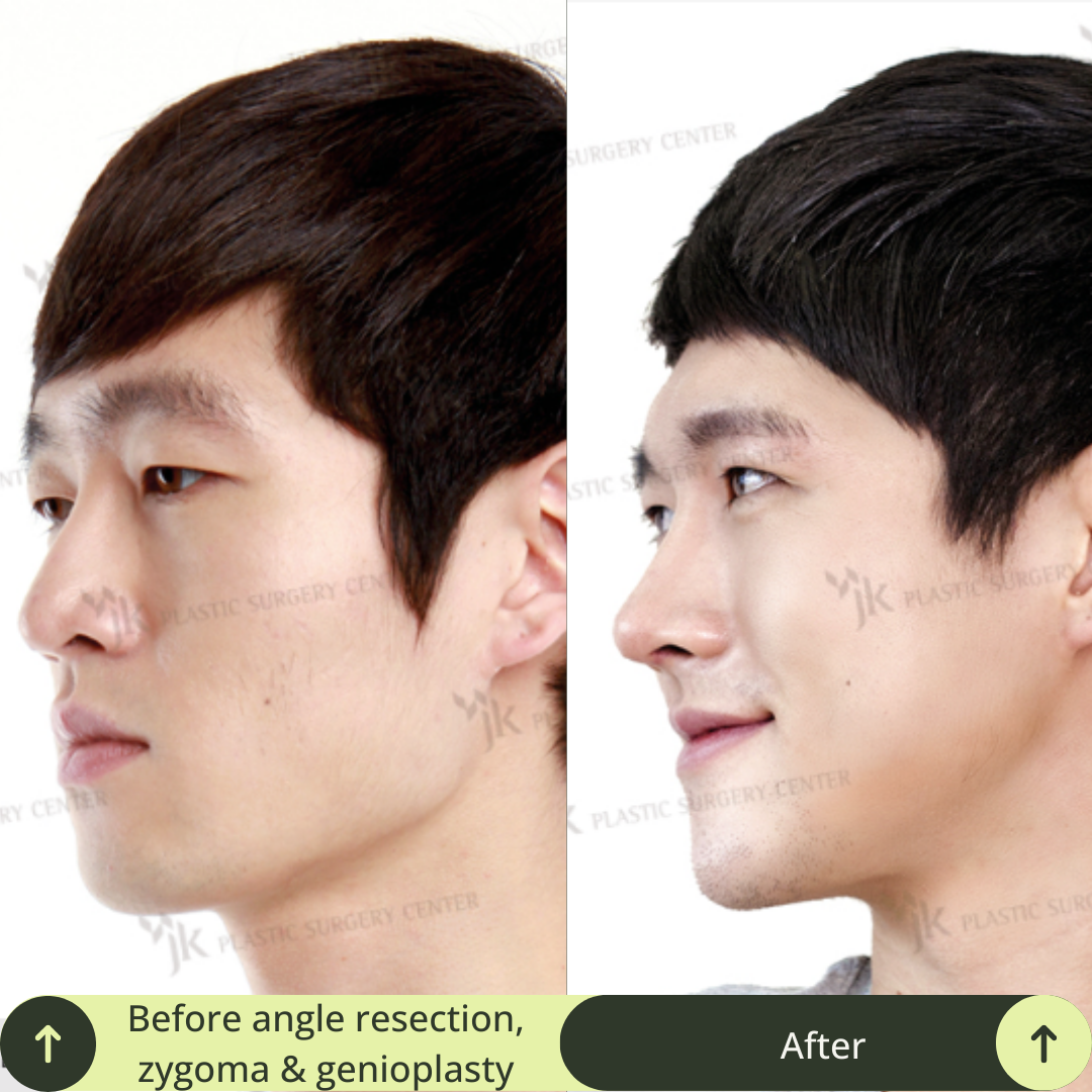 Men Vline Jaw Surgery Packages In South Korea