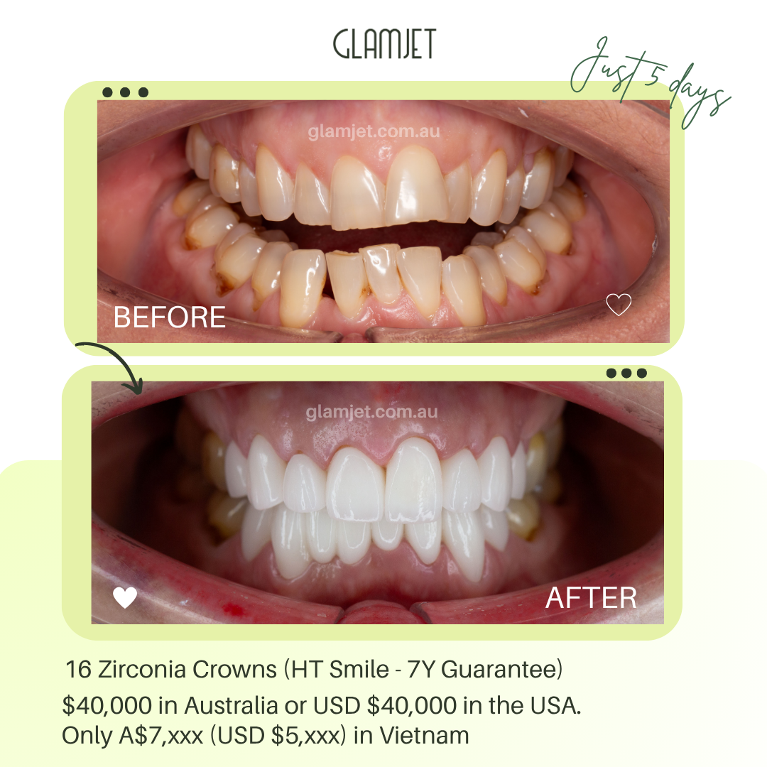 Before and after Darwin client’s crossbite and overbite correction smile transformation with zirconia crowns in Vietnam by Glamjet.com.au.