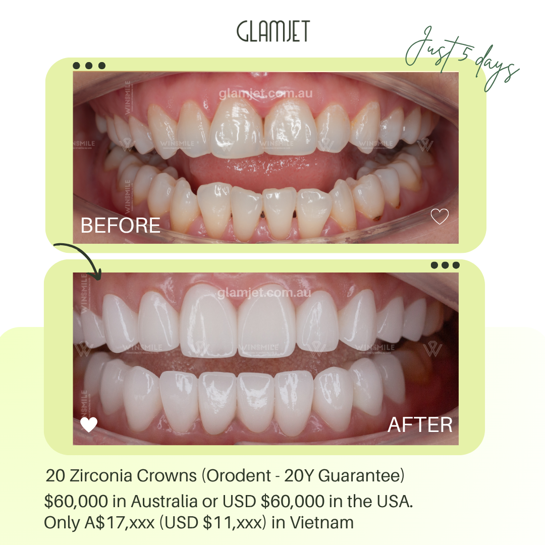 Before and after smile makeover of a Sydney, Australia client with short, uneven, discoloured teeth transformed in Vietnam through Glamjet.com.au. Achieved a natural, beautiful smile at a much more affordable price than in Australia, with no compromise on quality or care.